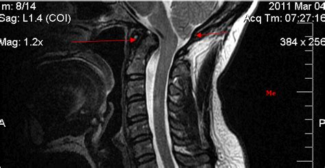 Ramblings of an Incredibly Large Brain: What is Basilar Invagination?