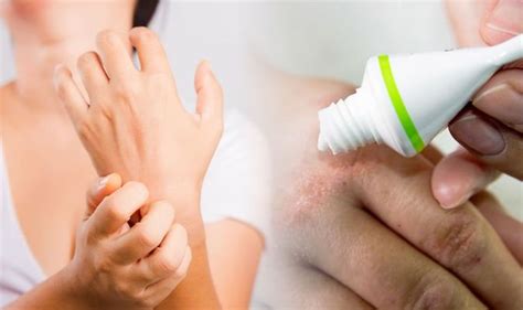 Eczema: Roseomonas mucosa could relieve the skin rash according to study | Express.co.uk