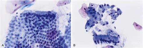 Cervical and Vaginal Cytology - Clinical Tree