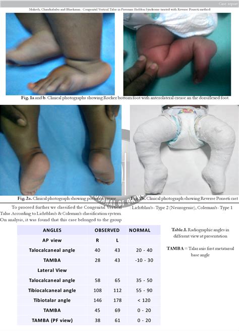 Figure 1 from Congenital Vertical Talus in Freeman Sheldon Syndrome treated with Reverse Ponseti ...