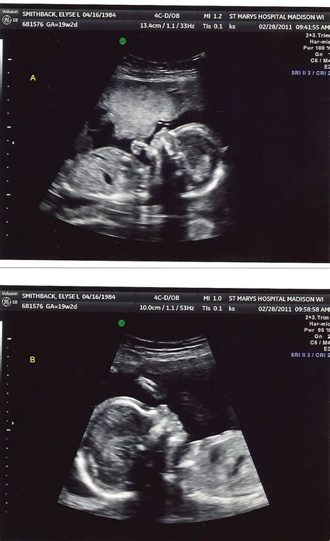 Smithback Twins: Ultrasound - 2 IDENTICAL BOYS!!