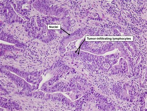 Adenocarcinoma Colon Histology