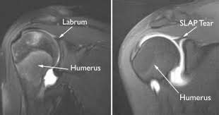 SLAP Lesion - Physiopedia