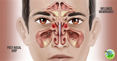 Another turn for stuffy nose is nasal congestion. Often, this is a ...