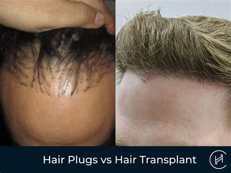 Hair Plugs vs Hair Transplant - Do You Know The Difference?