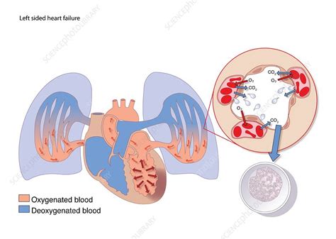 Left-sided heart failure, artwork - Stock Image - C009/0471 - Science ...