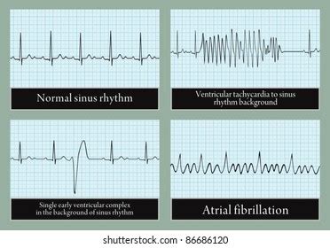 1,336 Abnormal Ekg Images, Stock Photos, 3D objects, & Vectors | Shutterstock