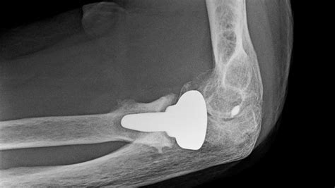 Press-fit radial head arthroplasty showing osteolysis, chondral... | Download Scientific Diagram