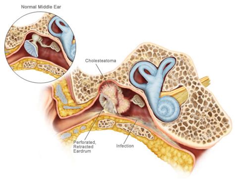 Causes, Symptoms, and Diagnosis for Cholesteatoma | Westside Head & Neck