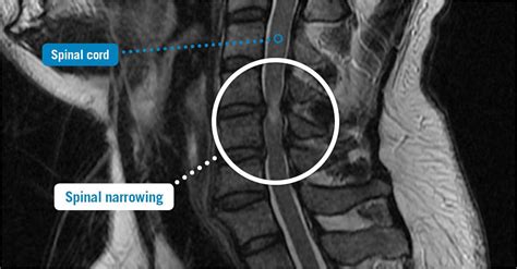 What is a Spine MRI - With Contrast | Cost | USA Spine Care