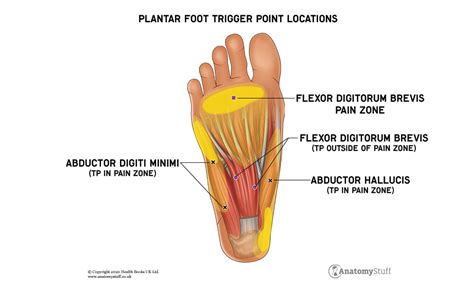 Understanding Trigger Points | Causes & Symptoms | AnatomyStuff