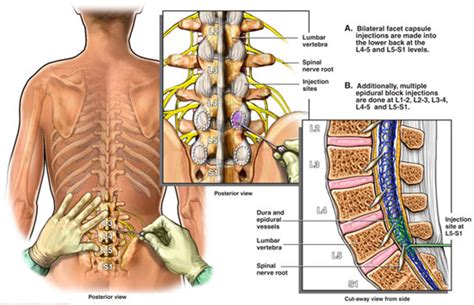 Patient Education of Back Pain