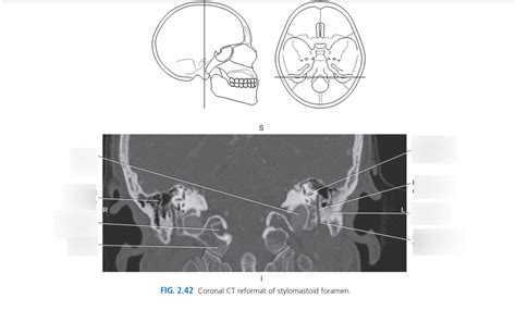 Coronal CT reformat of Stylomastoid foramen Diagram | Quizlet