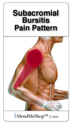 FST - Функционально-силовой тренинг: Subacromial Bursitis Symptoms