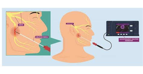 Radiofrequency Ablation: Purpose, Preparation, Aftercare, Recovery ...