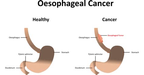 Oesophageal Cancer: Symptoms, Causes, Prevention and Treatments