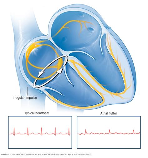 Atrial flutter - Mayo Clinic