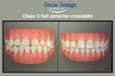 Fixing A Class 3 full anterior crossbite - Smile Design Dentistry Plymouth, MN