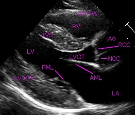 Parasternal long axis view in normal echocardiogram