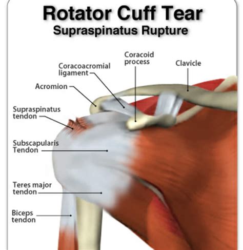 Rotator Cuff Recovery and Repair | Cawley Physical Therapy