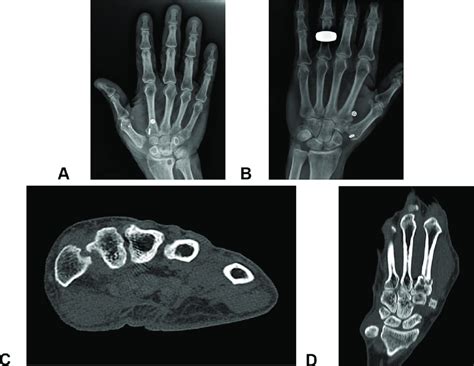 Complications associated with SBS for CMC arthroplasty. Representative... | Download Scientific ...