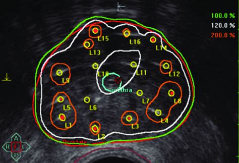 b. High-dose rate dose distribution. Prostate is outlined in red,... | Download Scientific Diagram