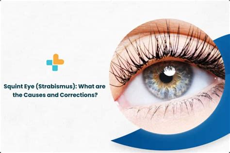 Squint Eye (Strabismus): What Are The Causes And Corrections?