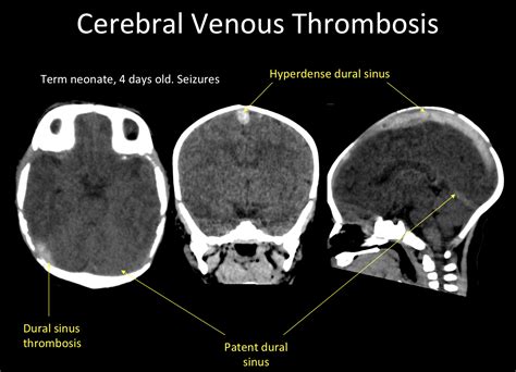 Superior Sagittal Sinus Thrombosis