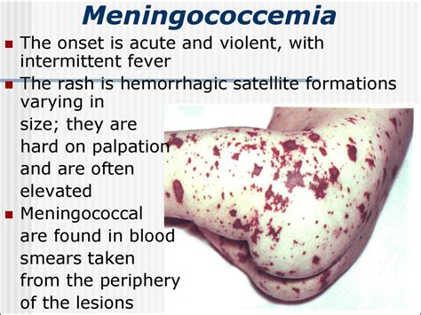 Meningococcal infection - презентация онлайн