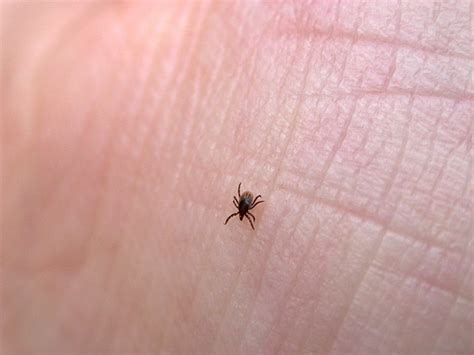 Know the signs of Lyme disease | Edward-Elmhurst Health