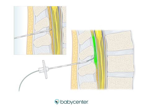 What are the pros and cons of having an epidural | BabyCenter