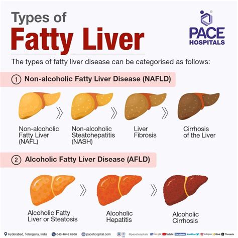 Fatty Liver Symptoms, Grade, Causes, Complications, Prevention