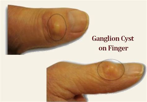 What is a Ganglion Cyst? Ganglion Cyst Removal without Surgery