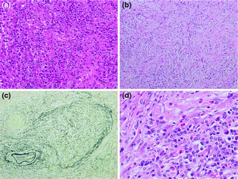 The Histopathology of IgG4-Related Disease | SpringerLink