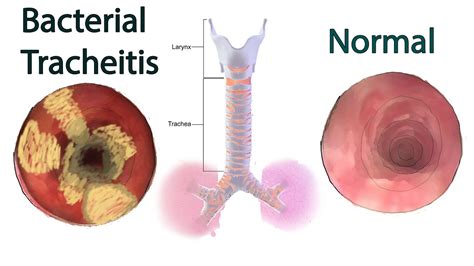 Bacterial Tracheitis - Symptoms, causes and treatment - YouTube