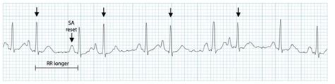 Premature Atrial Complex (PAC) • LITFL • ECG Library Diagnosis