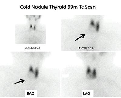 Thyroid Scan Cold Nodule