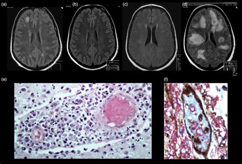 Vasculitis Mri Brain