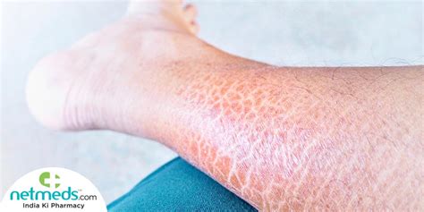 Ichthyosis Vulgaris: Causes: Symptoms And Treatment