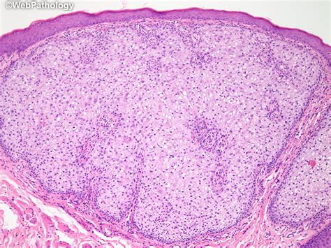 Webpathology.com: A Collection of Surgical Pathology Images