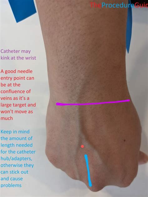 Peripheral Intravenous Access (IV) Technique Quick Guide - The ...