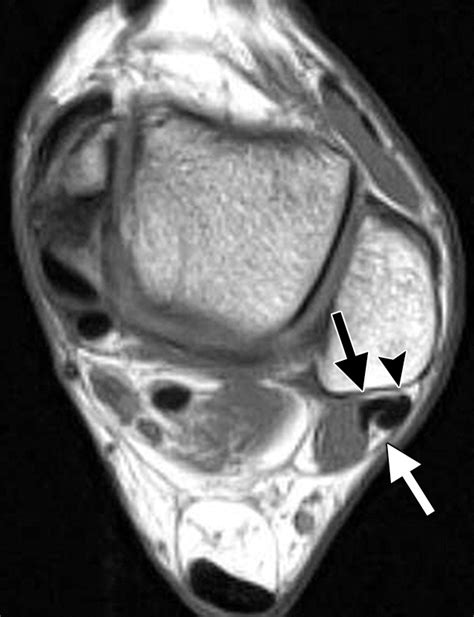 High-Resolution US and MR Imaging of Peroneal Tendon Injuries | RadioGraphics