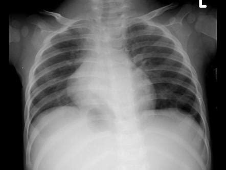 Pneumatocele | Radiology Reference Article | Radiopaedia.org