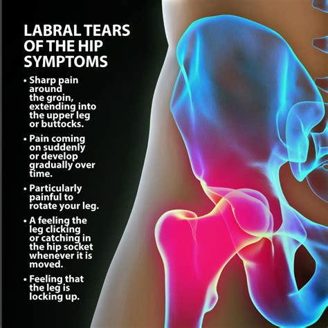 Hip Labral Tears | Florida Orthopaedic Institute