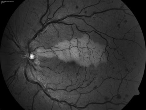 Cilioretinal Artery Occlusion with Central Retinal Vein Occlusion ...