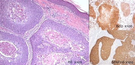 Metastatic basal cell carcinoma: a frequent disease with rare clinical ...