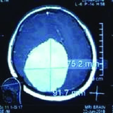 Brain MRI: axial Note: Axial sequence of brain MRI shows homogeneous ...