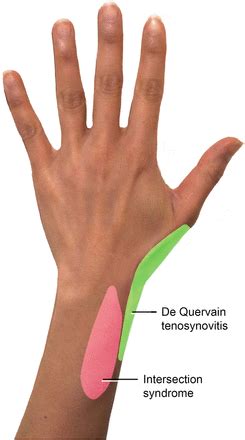 It's Not De Quervain Tenosynovitis – A Diagnosis to Consider in Persistent Wrist Pain | Ochsner ...