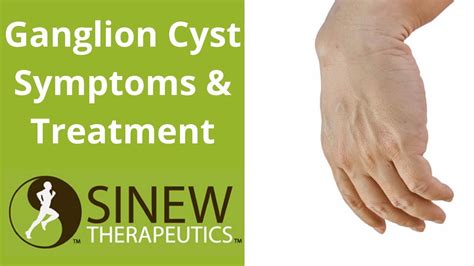 Ganglion Cyst Symptoms and Treatment - YouTube