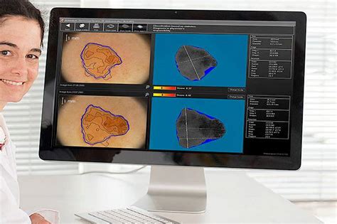 Total Body Dermoscopy | Melanoma Monitoring | Skin Care Network